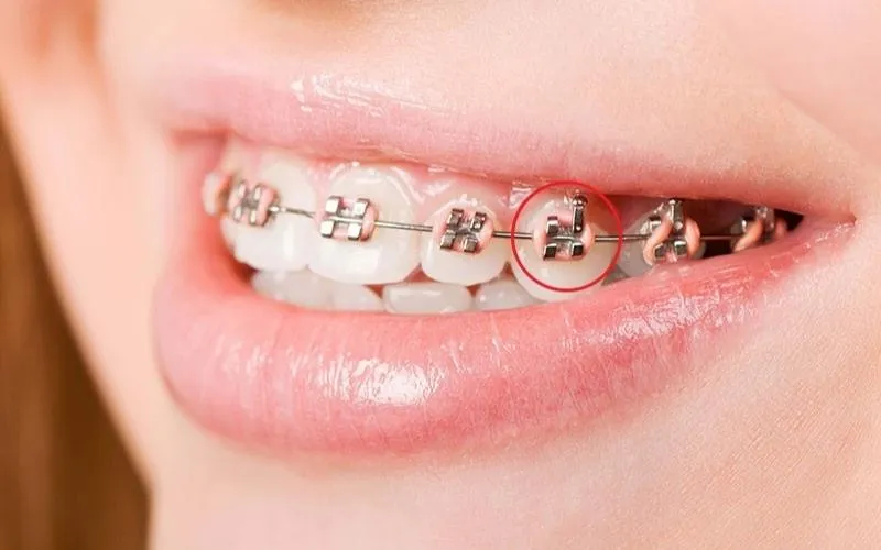 Các cách giảm đau sau khi siết niềng răng