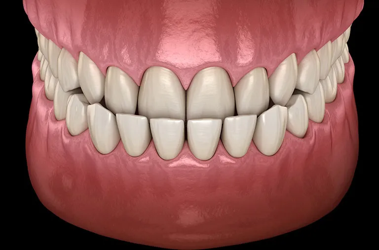 Các phương pháp điều trị khớp cắn ngược