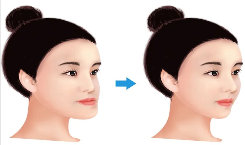 Răng móm là gì? Nguyên nhân, triệu chứng và cách điều trị 9 Cách khắc phục tình trạng móm