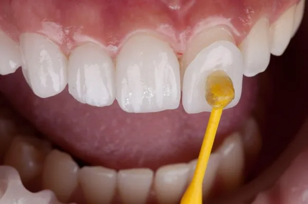 Cách phục hồi răng bị mẻ