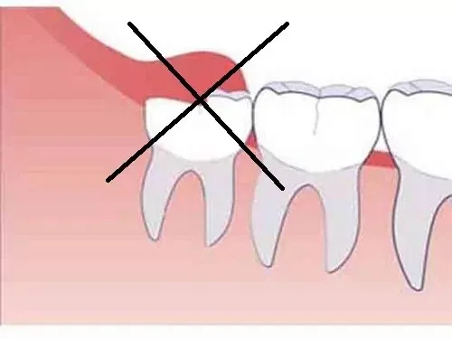 Có nên thực hiện cắt lợi trùm hay không
