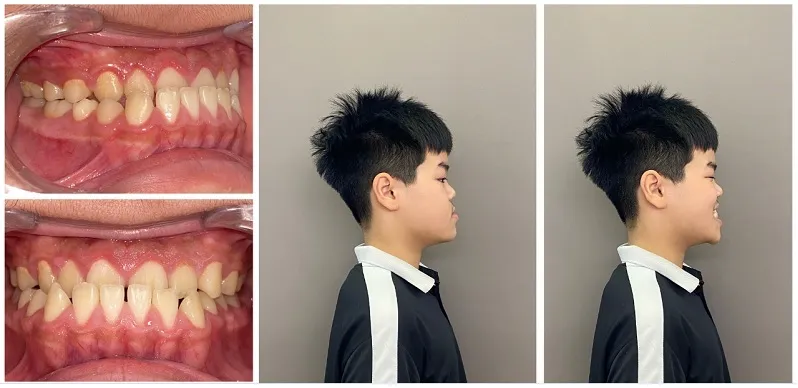 Răng móm là gì? Nguyên nhân, triệu chứng và cách điều trị 7 Dấu hiệu miệng bị móm