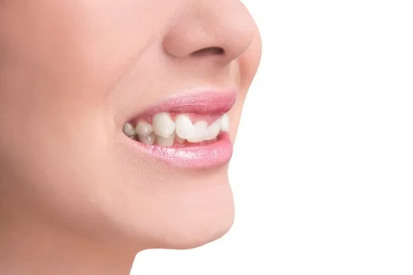 Khớp cắn sâu là gì? Nguyên nhân, tác hại và cách điều trị 8 Dấu hiệu nhận biết khớp cắn sâu