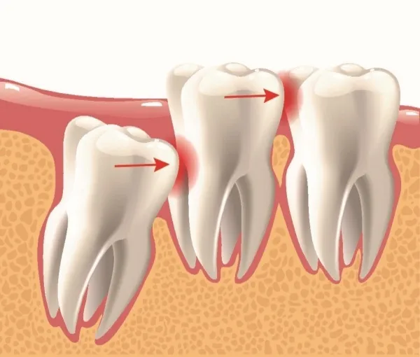 Dấu hiệu răng mọc ngầm