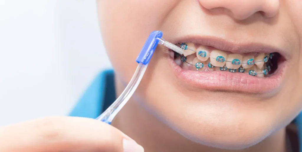 Bàn chải kẽ răng loại nào tốt? Cách sử dụng và lưu ý 4 Hướng dẫn sử dụng bàn chải kẽ răng đúng cách