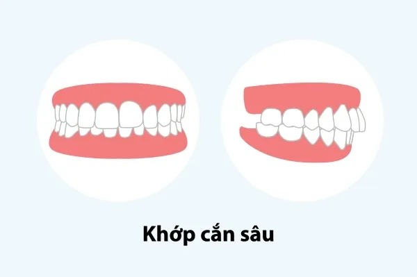 Khớp cắn sâu là gì? Nguyên nhân, tác hại và cách điều trị