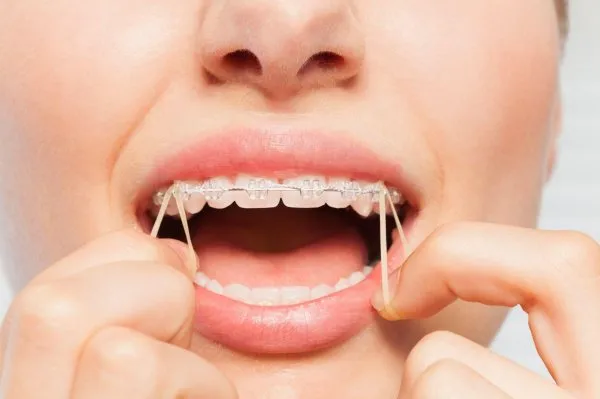 Lợi ích của dây thun niềng răng