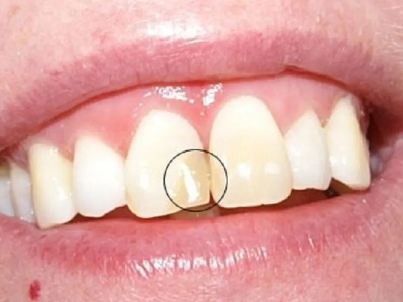 Lý do cần phục hồi răng bị mẻ