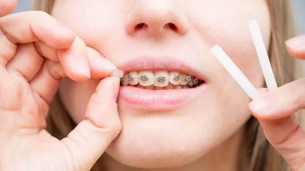 Một số điều cần lưu ý khi siết răng niềng