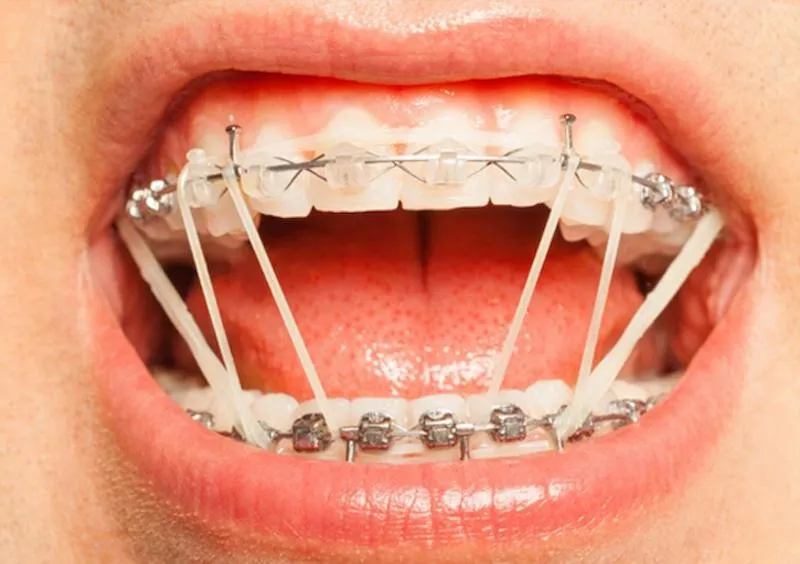 Mua thun niềng răng ở đâu