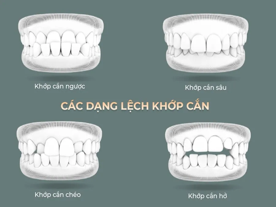 Lệch khớp cắn là gì? Nguyên nhân, dấu hiệu và cách điều trị 9 Nguyên nhân gây lệch khớp cắn
