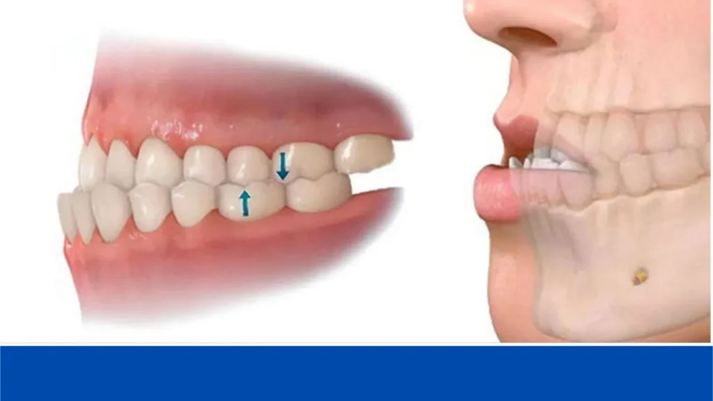 Nguyên nhân gây ra tình trạng khớp cắn ngược