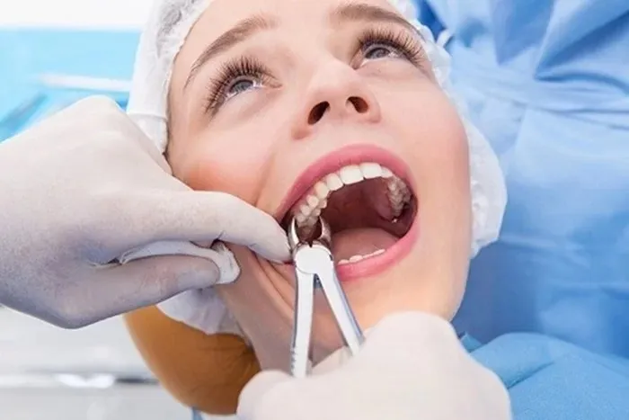Những câu hỏi thường gặp về nhổ răng hàm