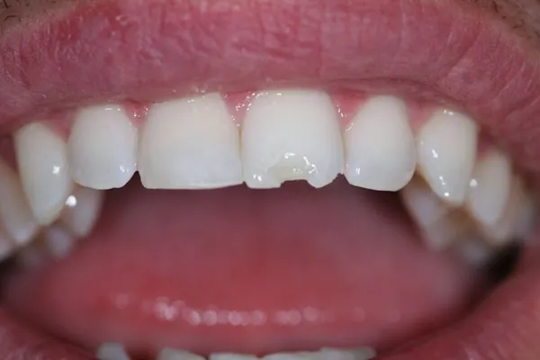 Những trường hợp răng bị mẻ