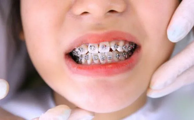 Trẻ nghiến răng khi ngủ: Nguyên nhân, cách điều trị tận gốc 11 Niềng răng để điều chỉnh khớp cắn sai lệch