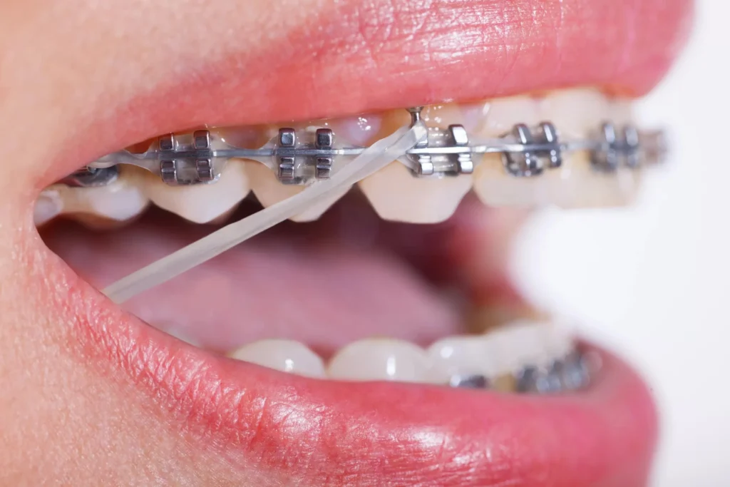 Phân loại và công dụng của dây thun niềng răng