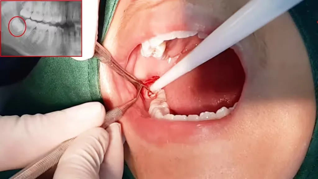 Phẫu thuật nhổ bỏ răng mọc ngầm