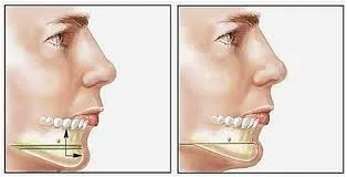 Phẫu thuật tạo hình cằm lẹm