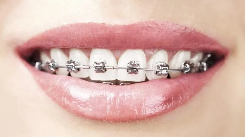 Lệch khớp cắn là gì? Nguyên nhân, dấu hiệu và cách điều trị 10 Phương pháp điều trị lệch khớp cắn