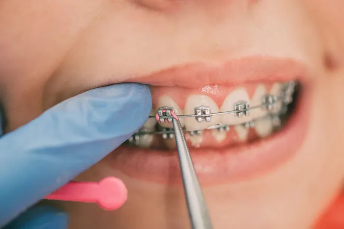 Quy trình siết răng khi niềng 