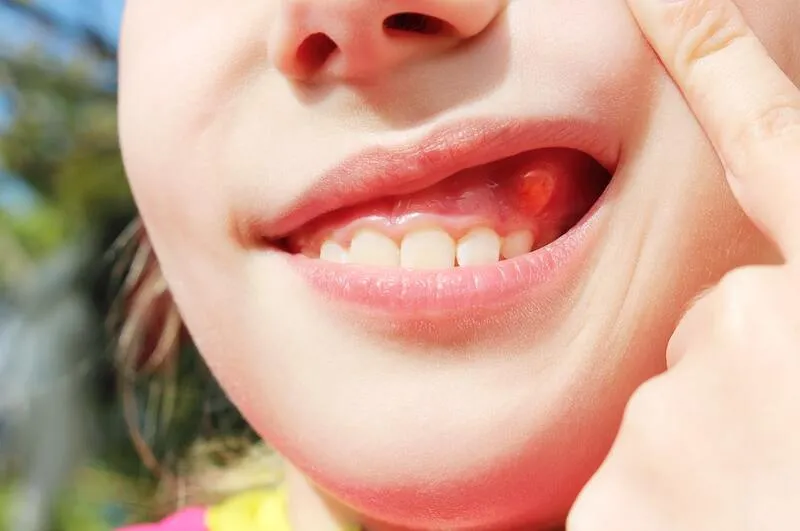 Răng mọc ngầm có nguy hiểm không