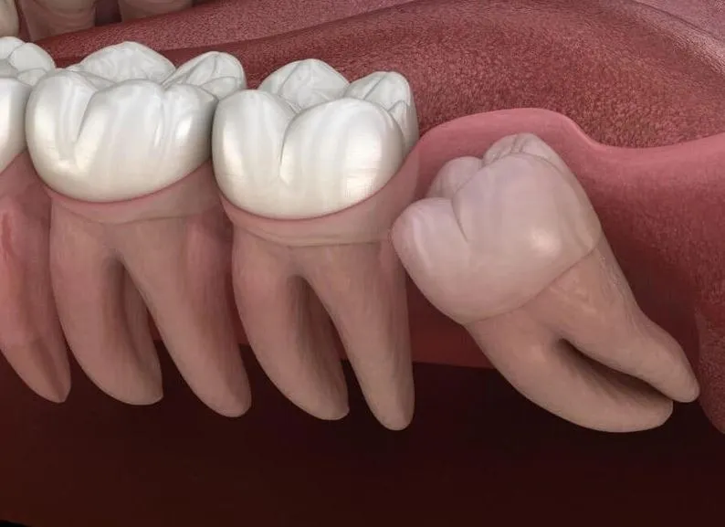 Răng mọc ngầm là gì? Dấu hiệu, nguyên nhân và cách điều trị