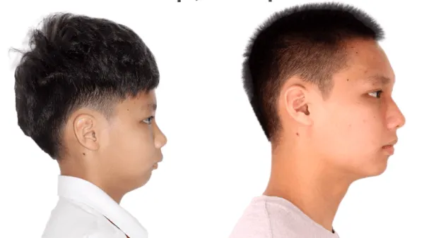 Tác động của cằm lẹm đến thẩm mỹ và tâm lý