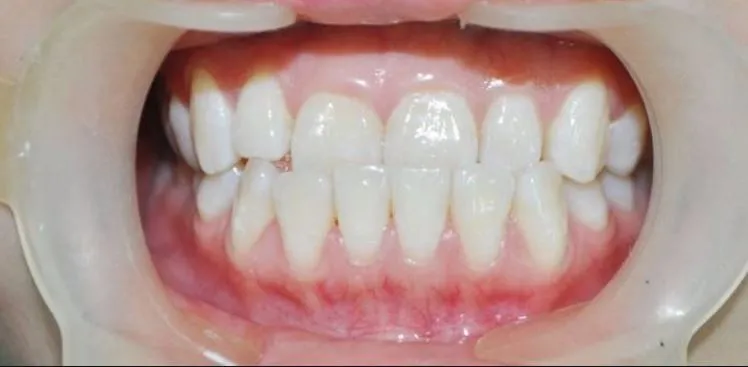 Tác hại của tình trạng khớp cắn ngược