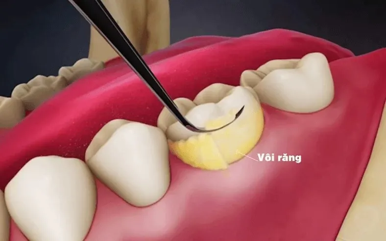 Tại sao cần loại bỏ vết đen trên răng