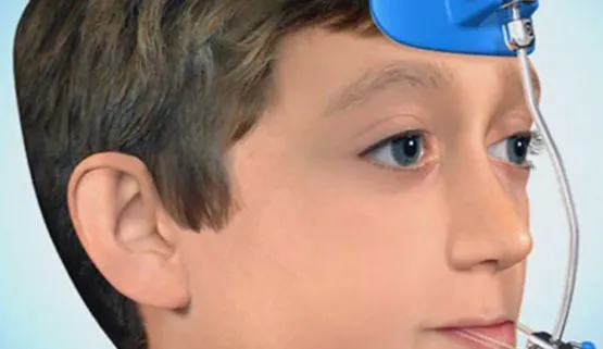 Thời điểm thích hợp để sử dụng hàm Facemask chỉnh nha cho trẻ