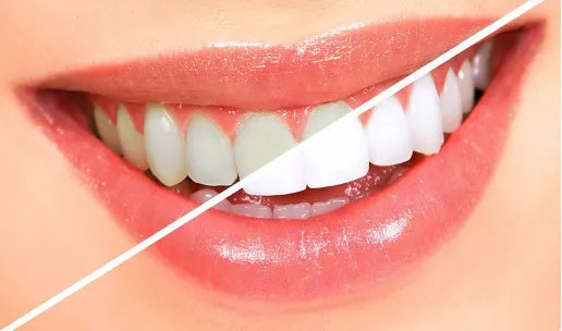 5 Cách làm trắng răng tại nhà nhanh nhất mà không tốn tiền
