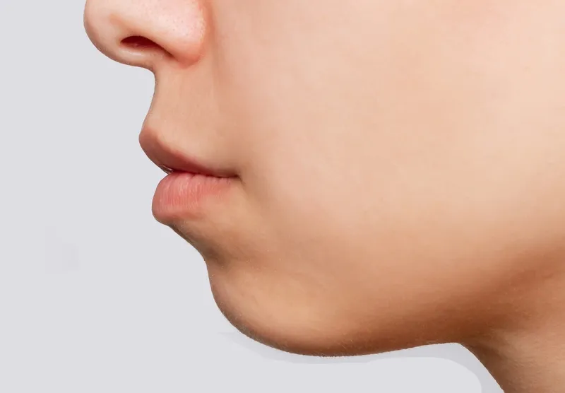 Cằm lẹm là như thế nào? Nguyên nhân và cách khắc phục