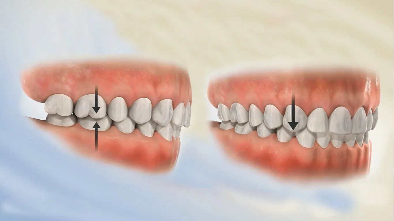 Lệch khớp cắn là gì? Nguyên nhân, dấu hiệu và cách điều trị