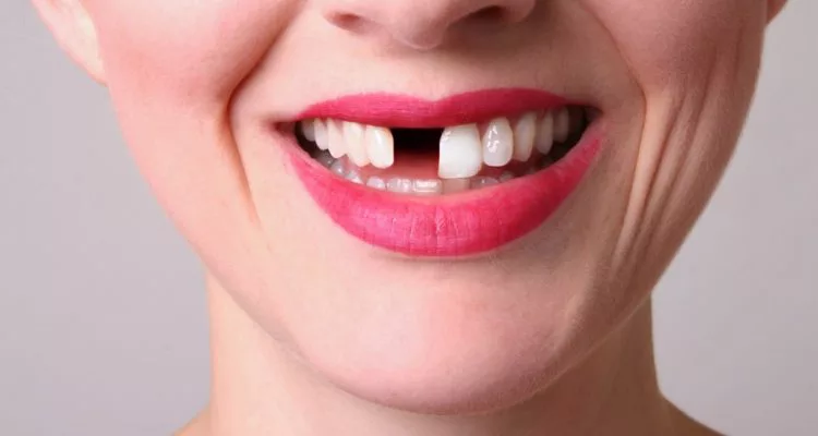 Bị mất răng cửa có nghiêm trọng không và cách khắc phục