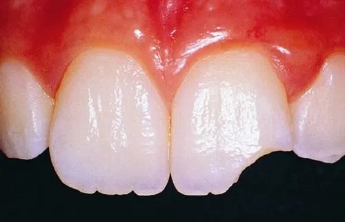 Các nguyên nhân dẫn đến tình trạng răng bị mẻ