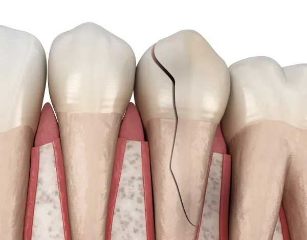 Răng bị nứt là gì? Nguyên nhân, dấu hiệu và cách điều trị