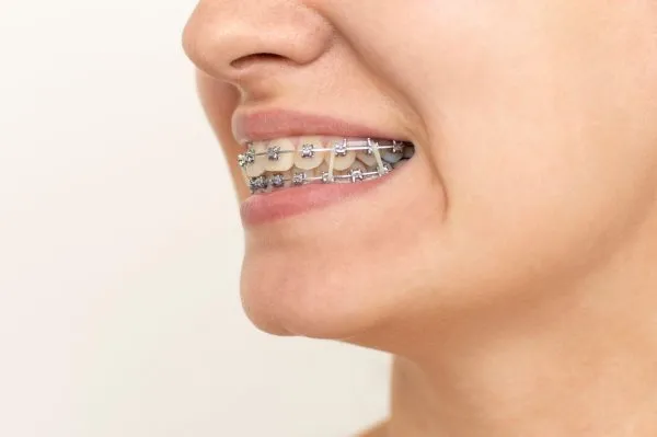 Dây thun niềng răng là gì? Có những loại nào và cách dùng
