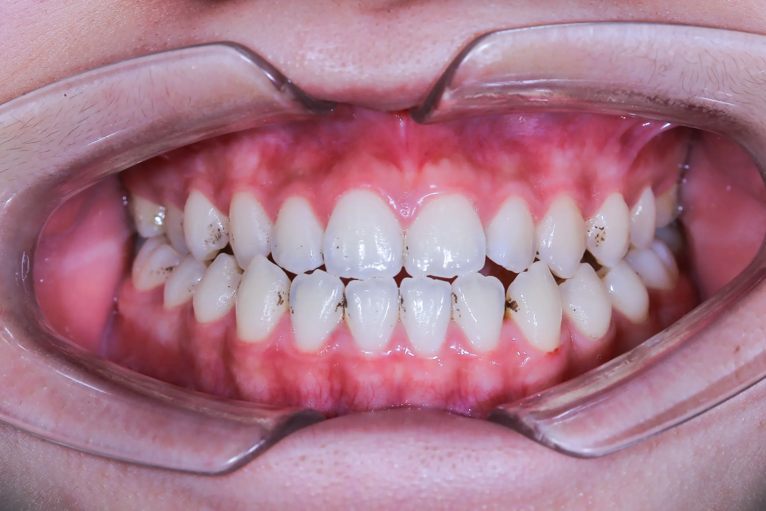 Ba phương pháp niềng răng để điều chỉnh khớp cắn đối đầu