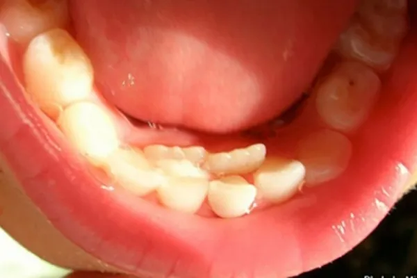 Các loại răng mọc thừa ở hàm dưới