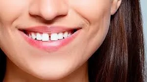 Vận mệnh người răng sở hữu răng cửa to và cách khắc phục 8 Cách khắc phục răng cửa to hiệu quả 1111
