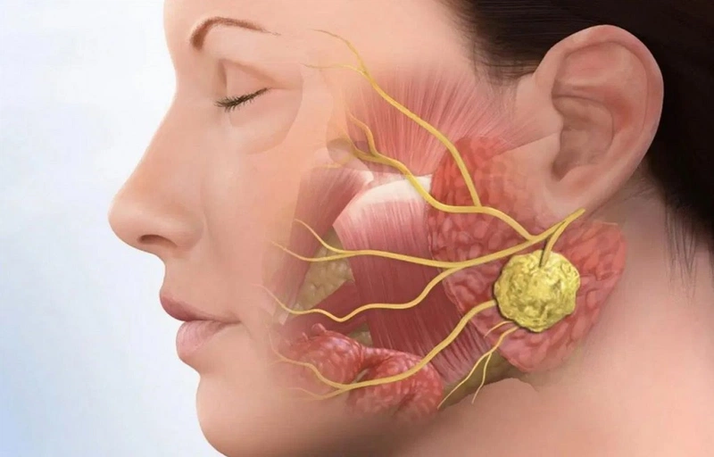 Viêm khớp thái dương hàm có tự khỏi không? Cách điều trị 12 6. Chọc rửa khớp viêm