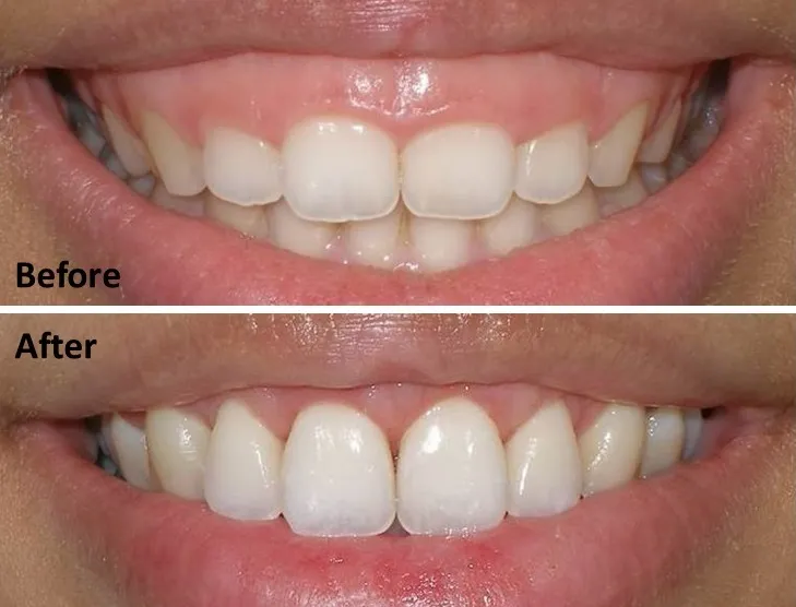 Điều trị cười hở lợi bằng phương pháp nào hiệu quả?