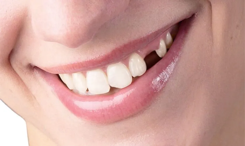 Giảm thẩm mỹ và khó khăn trong giao tiếp