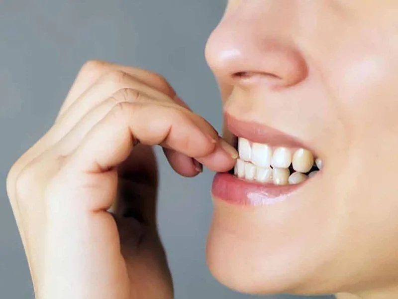 Trám răng Inlay, Onlay, Overlay là gì? Ưu nhược điểm 5 Hỗ trợ răng yếu
