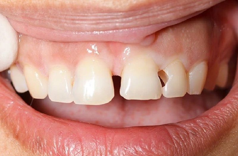 Hướng dẫn chăm sóc và phòng ngừa răng bị mẻ 22