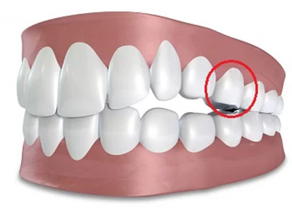 Khi nào cần nhổ răng số 5?