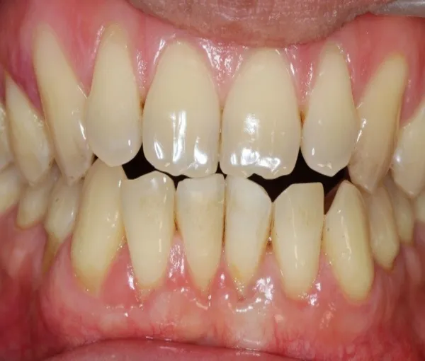 Khớp cắn đối đầu là gì?