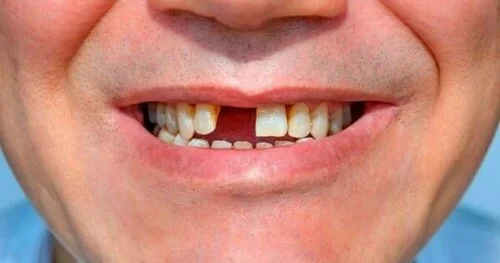 Mất cân bằng lực nhai, gây đau đầu và đau vai gáy