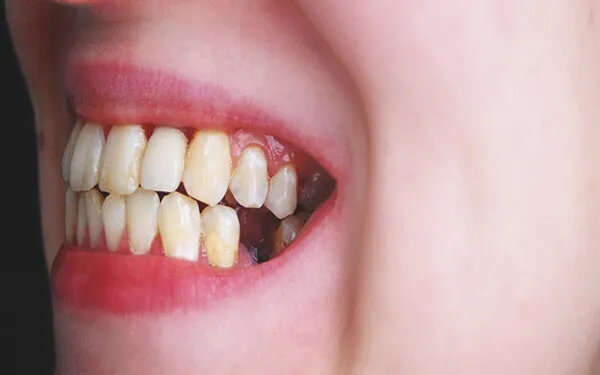 Nhận biết răng sâu bị vỡ chỉ còn chân răng 33
