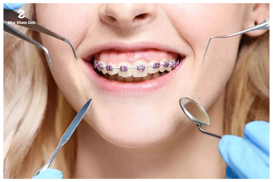 Vận mệnh người răng sở hữu răng cửa to và cách khắc phục 9 Niềng răng chỉnh nha